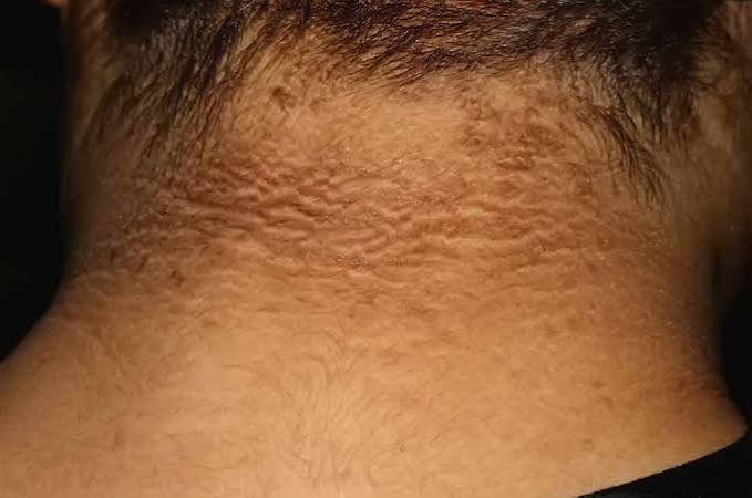 dermatologist examining acanthosis nigricans on the neck of a patient with insulin resistance and type 2 diabetes