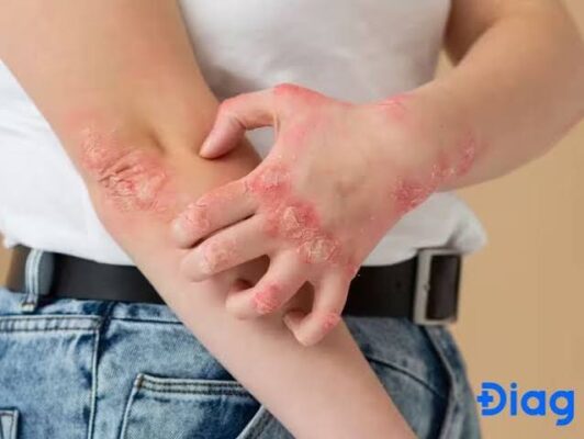 close-up of dry cracked skin on the lower leg of a person with diabetes showing signs of diabetic dermopathy and poor circulation