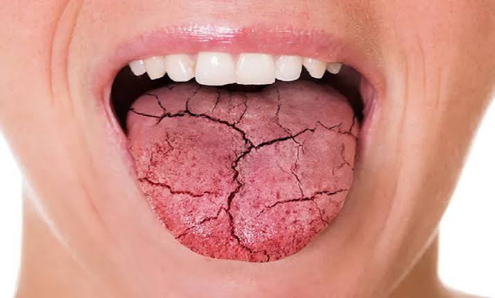 diabetes dry mouth showing oral health impact of high blood sugar on salivary glands and dental health