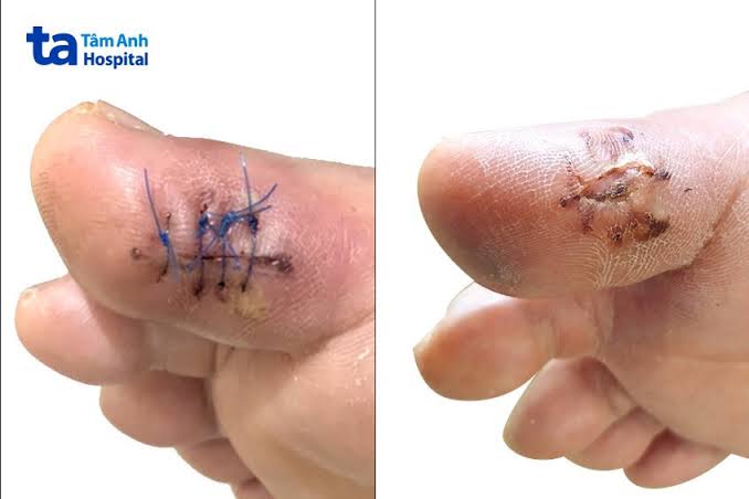 diabetes infection complications — diagram of most common infections in diabetes including urinary tract infections skin infections pneumonia and fungal infections