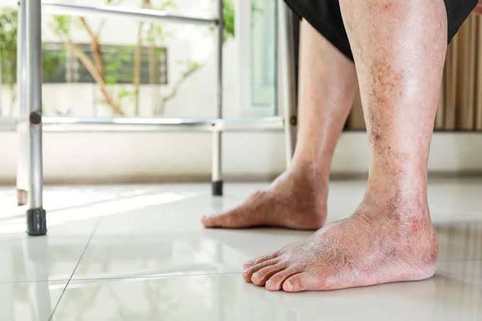 diabetes skin conditions showing how hyperglycemia and poor circulation impair skin barrier function and raise infection risk
