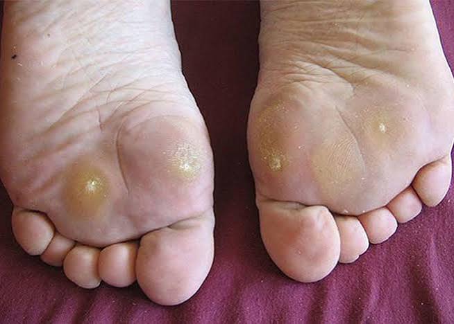 diabetic foot ulcer stages — progression from callus and pressure point to neuropathic ulcer showing how loss of protective sensation allows undetected foot injury in diabetes