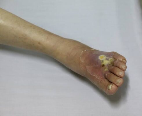 diabetic foot problems prevention — healthcare provider examining diabetic patient foot for ulcers calluses and circulation problems during annual foot exam