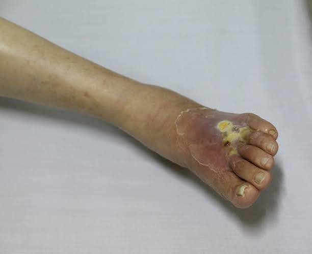 diabetic foot problems prevention — healthcare provider examining diabetic patient foot for ulcers calluses and circulation problems during annual foot exam