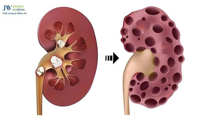diabetic kidney disease warning signs — urine sample and blood test showing elevated albumin and reduced eGFR indicating chronic kidney disease stages in diabetes