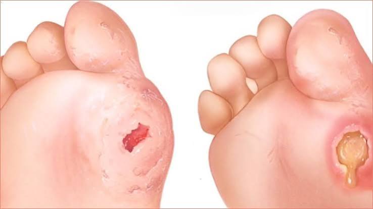 diabetic peripheral neuropathy progression from tingling and burning to numbness and loss of protective sensation