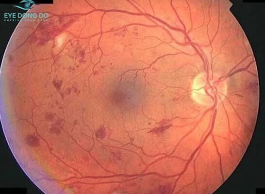 diabetic retinopathy eye damage — retinal photograph showing microaneurysms hemorrhages and neovascularization from chronic high blood glucose in diabetes