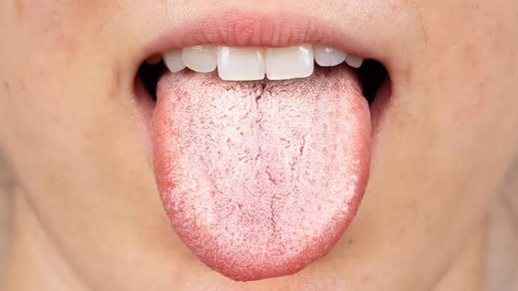 dry mouth and high blood sugar showing xerostomia from hyperglycemia and reduced salivary gland function