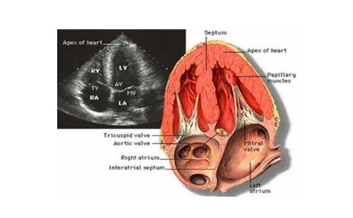 Echocardiogram Doppler valve disease mitral stenosis aortic regurgitation severity measurement continuous wave