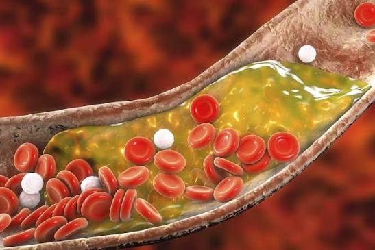 Soluble fiber foods for cholesterol — oat bran, psyllium, lentils, and avocado arranged together