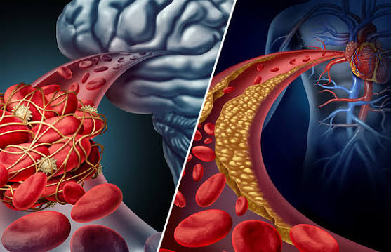 Heart attack vs angina comparison showing partial vs complete coronary artery blockage mechanisms