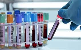 How often should cholesterol be checked — blood test vial and cholesterol lipid panel report on a medical background