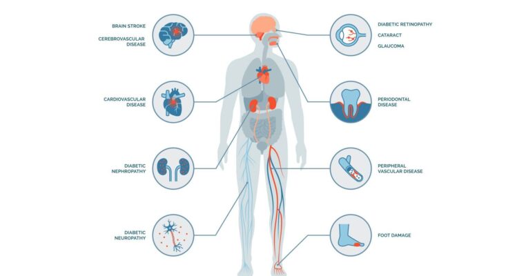 illness and blood sugar showing counterregulatory hormone response with cortisol glucagon and epinephrine raising glucose during sickness