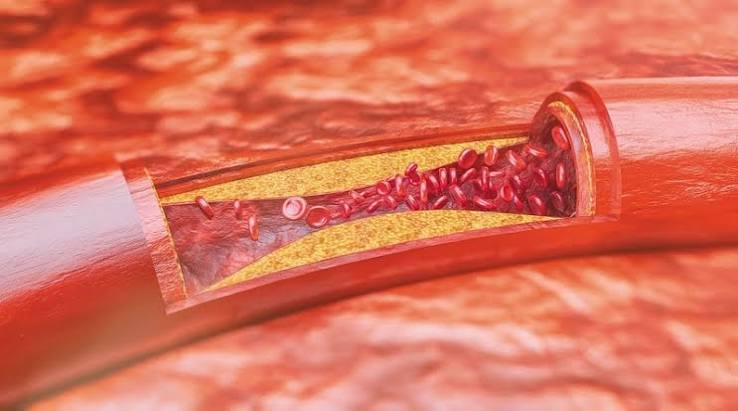 insulin resistance caused by visceral fat inflammation affecting insulin signaling pathways