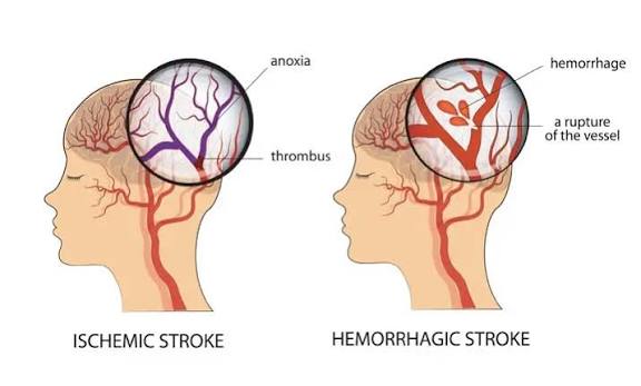 Intracerebral hemorrhage from hypertensive bleeding in basal ganglia showing blood expansion on CT scan