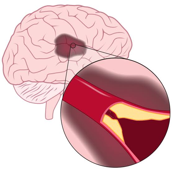 Ischemic vs hemorrhagic stroke comparison on CT brain scan showing clot versus bleeding mechanisms
