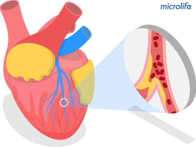 Lipid panel cholesterol levels LDL HDL triglycerides lab results showing cardiovascular and stroke risk assessment