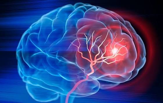 Mini-stroke TIA symptoms brain MRI diffusion-weighted imaging showing transient ischemia without infarction