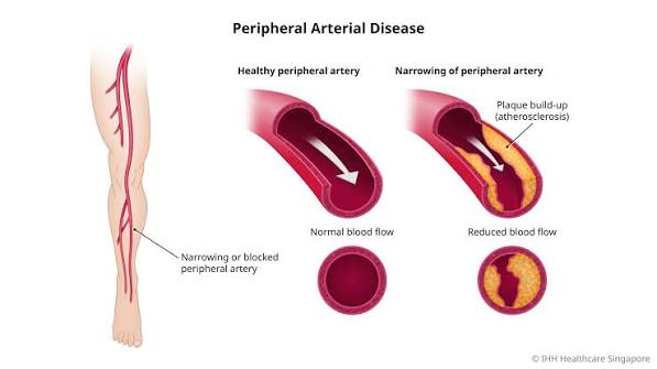 Peripheral artery disease diagnosis duplex ultrasound vascular imaging showing femoral artery stenosis blood flow