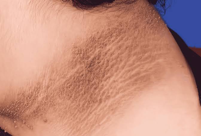 skin changes and diabetes showing acanthosis nigricans and diabetic dermopathy as common diabetes skin conditions