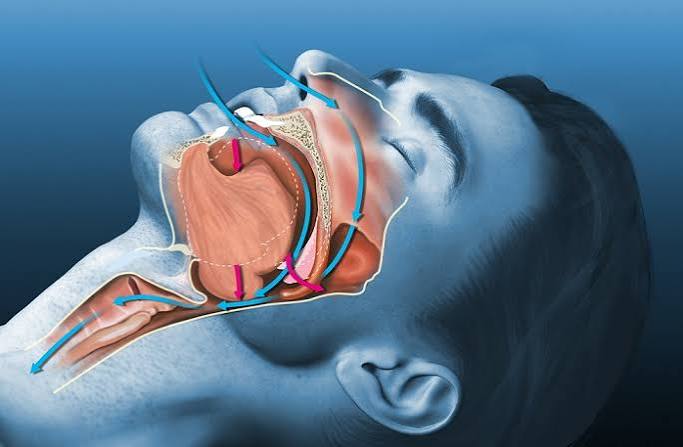 Sleep study polysomnography equipment for diagnosing sleep apnea and protecting cardiovascular health