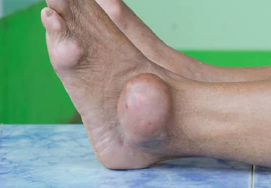 Swollen ankles treatment compression stockings leg elevation diuretics salt restriction venous edema management