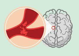TIA ABCD2 score risk stratification clinical decision tool for predicting 2-day stroke risk after transient ischemic attack