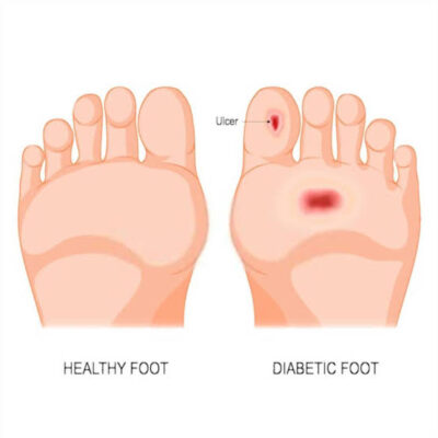 tingling feet and diabetes showing peripheral neuropathy nerve damage symptoms in feet and lower legs