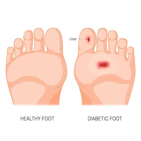 tingling feet and diabetes showing peripheral neuropathy nerve damage symptoms in feet and lower legs