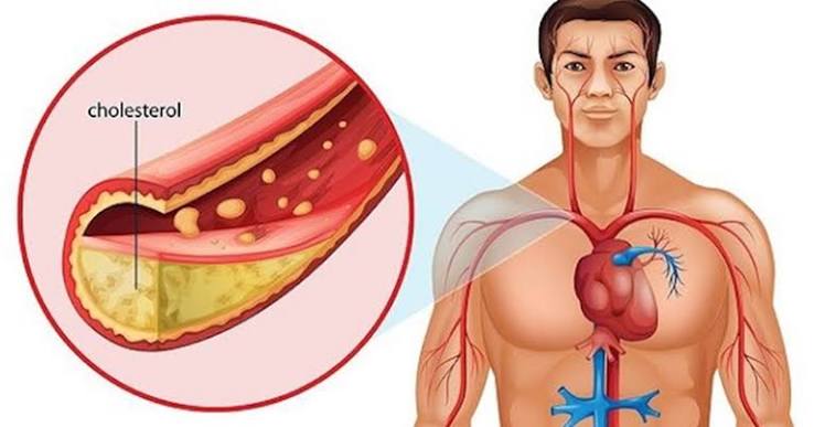 Trans fat and heart health — partially hydrogenated oil, margarine, and processed snacks on a table