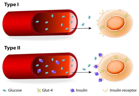 type 1 vs type 2 diabetes comparison showing immune attack and insulin resistance