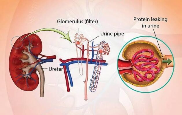 urine albumin test diabetes — urine sample collection cup for microalbumin testing to detect early kidney damage from diabetes before symptoms appear