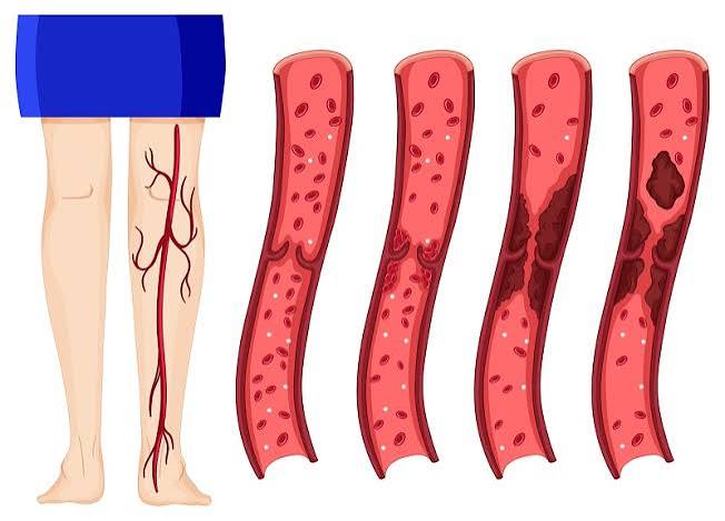 Varicose veins and poor circulation twisted bulging purple leg veins venous insufficiency chronic venous hypertension