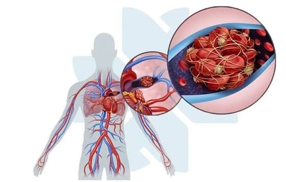 Varicose veins venous insufficiency duplex ultrasound reflux great saphenous vein ablation treatment options