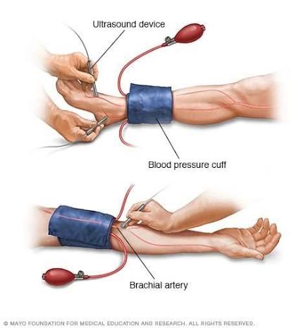 Vascular ultrasound deep vein thrombosis DVT venous duplex renal artery abdominal aortic aneurysm diagnosis evaluation