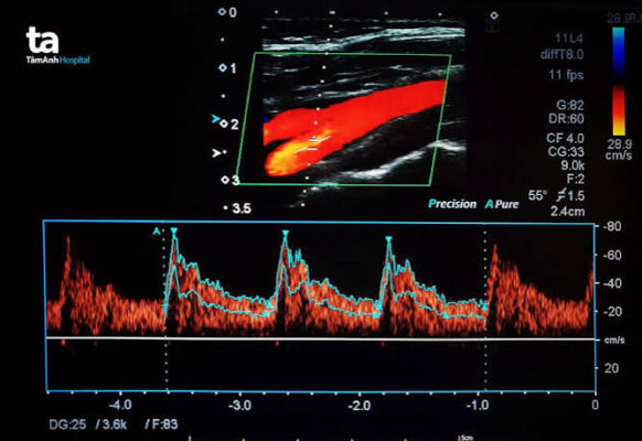 Vascular ultrasound duplex Doppler carotid artery peripheral arterial disease plaque stenosis circulation blood flow imaging