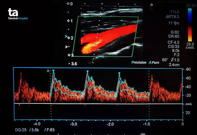 Vascular ultrasound duplex Doppler carotid artery peripheral arterial disease plaque stenosis circulation blood flow imaging