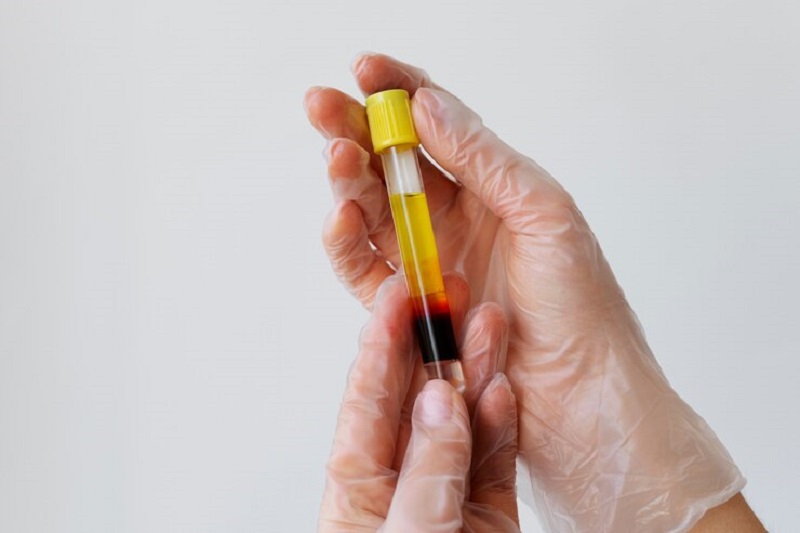 Lipid panel preparation — fasting before cholesterol blood test