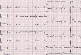 What is an electrocardiogram 12 lead ECG waveform P wave QRS complex T wave heart electrical activity recording