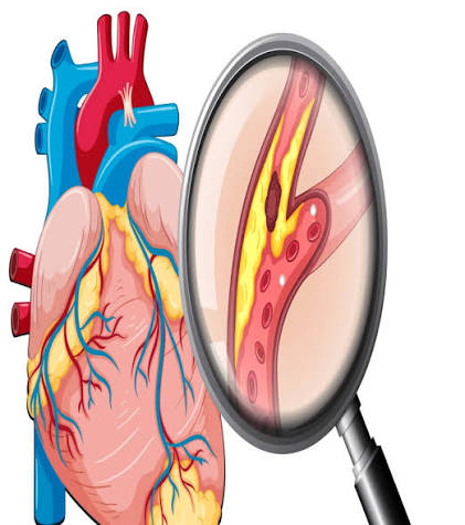 Atherosclerosis diagnosis — coronary artery calcium scan and lipid panel blood test