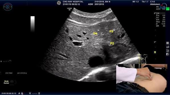 abdominal ultrasound what it can show — liver gallbladder kidneys pancreas spleen imaging ultrasound probe