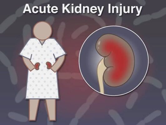 Diagram of acute kidney injury causes stages and diagnosis including pre-renal intrinsic and post-renal AKI