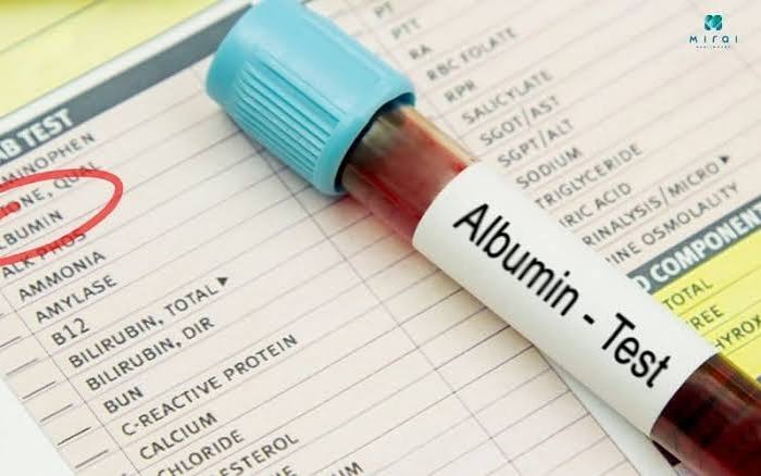 albumin-and-liver-function-body — low albumin causes cirrhosis ascites oedema hypoalbuminaemia