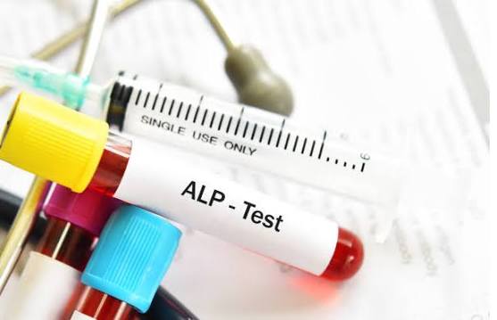 alkaline-phosphatase-test-explained-body — ALP elevation causes primary biliary cholangitis PSC bone disease GGT