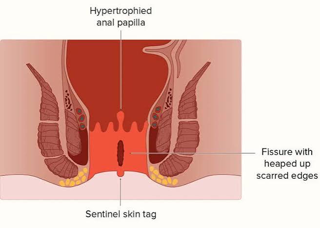 Warm sitz bath preparation with a plastic sitz bath fitting on a toilet — used for anal fissure treatment to reduce sphincter spasm and improve perianal blood flow