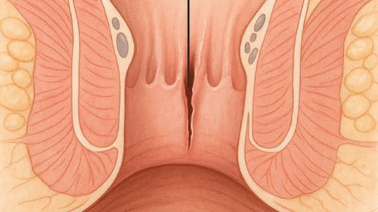 Medical illustration of the anal canal showing a posterior midline anal fissure with sentinel skin tag, internal sphincter and dentate line labelled