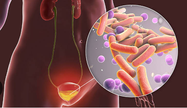 antibiotics for UTI — patient reviewing antibiotic prescription with pharmacist for urinary tract infection treatment including nitrofurantoin and trimethoprim-sulfamethoxazole