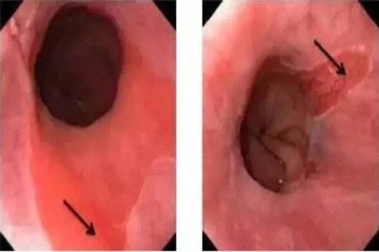 Barrett's esophagus intestinal metaplasia dysplasia adenocarcinoma surveillance endoscopy