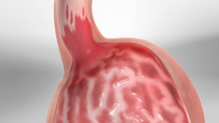 Barrett's esophagus radiofrequency ablation RFA endoscopic eradication treatment