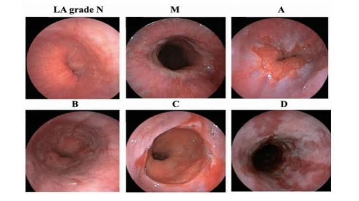 Barrett's oesophagus GERD complication versus gastric intestinal metaplasia gastritis complication